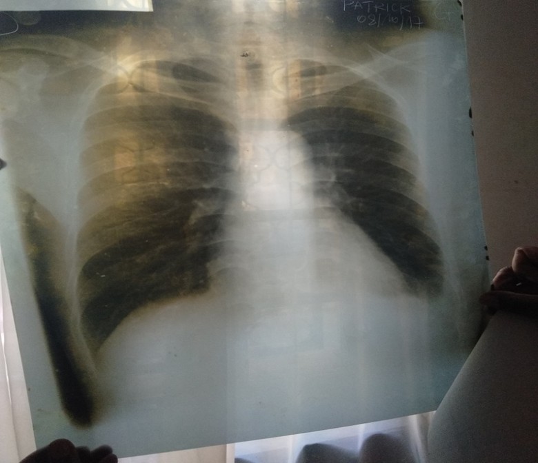 Röntgenaufnahme eines Oberkörpers